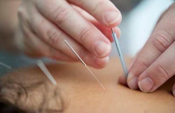 Comment l'Acupuncture Peut Efficacement Soulager la Douleur: Techniques et Témoignages